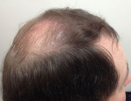 Before mens hair systems in liverpool