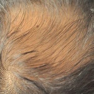 thinning hair solutions at hair transform Liverpool thinning hair solutions at hair transform Liverpool