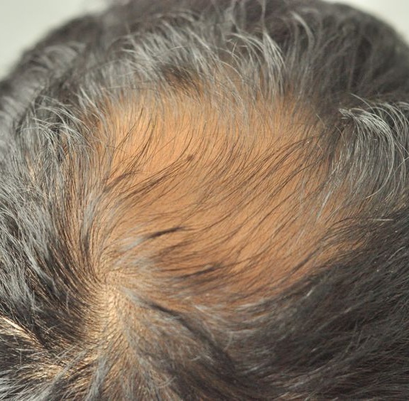 hair loss treatments at hair transform salon liverpool