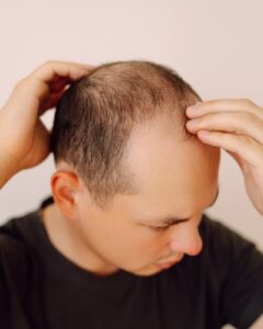 hair loss clinic Liverpool Hair Transform hair loss clinic Liverpool Hair Transform