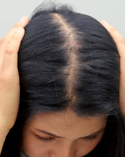 What Causes Hair Loss in Men and Women? What Causes Hair Loss in Men and Women?